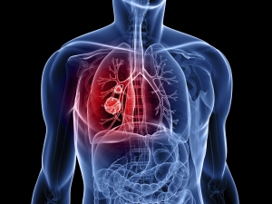 Οι υπολογιστές μπορούν να κάνουν πιο ακριβείς διαγνώσεις του καρκίνου των πνευμόνων από τους γιατρούς