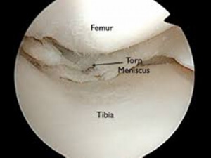 Έπαθα ρήξη μηνίσκου του γόνατος. Χρειάζομαι χειρουργείο;