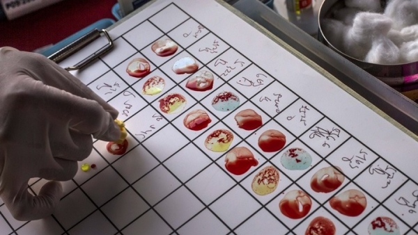 Δεν έχουν όλες οι ομάδες αίματος τον ίδιο κίνδυνο για εγκεφαλικό πριν τα 60