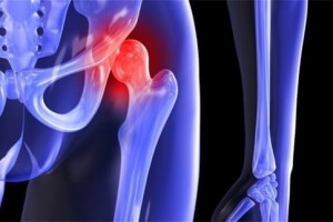 Κατάγματα του ισχίου