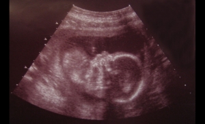 Ανακαλύφθηκε μια άγνωστη έως τώρα αιτία πολλών πρόωρων τοκετών, που σχετίζεται με το ασβέστιο