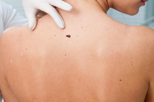 Νέα τεχνική διάγνωσης του καρκίνου του δέρματος από δύο Ελληνίδες ερευνήτριες στις ΗΠΑ